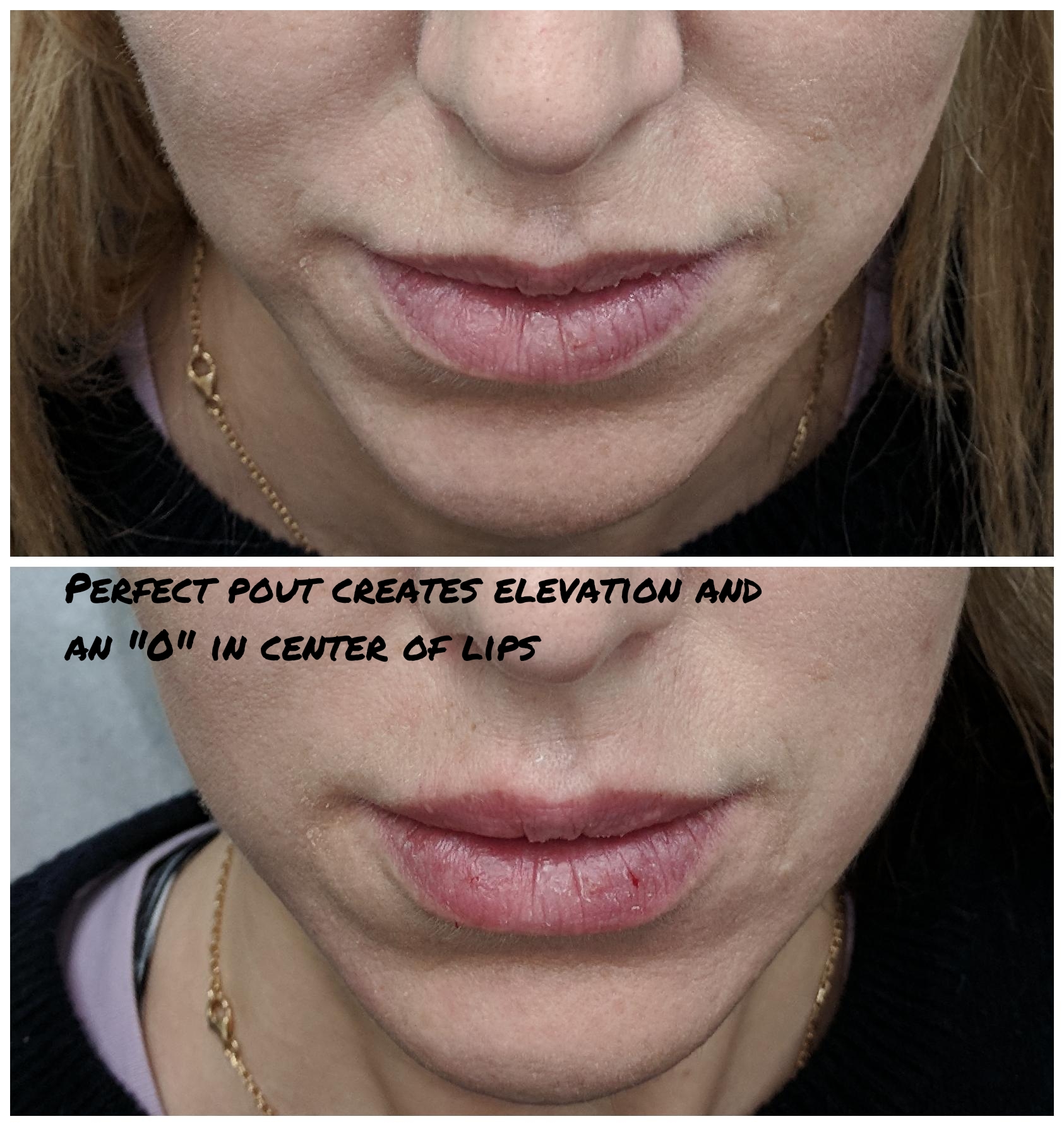 Fillers to lips and nasolabial folds