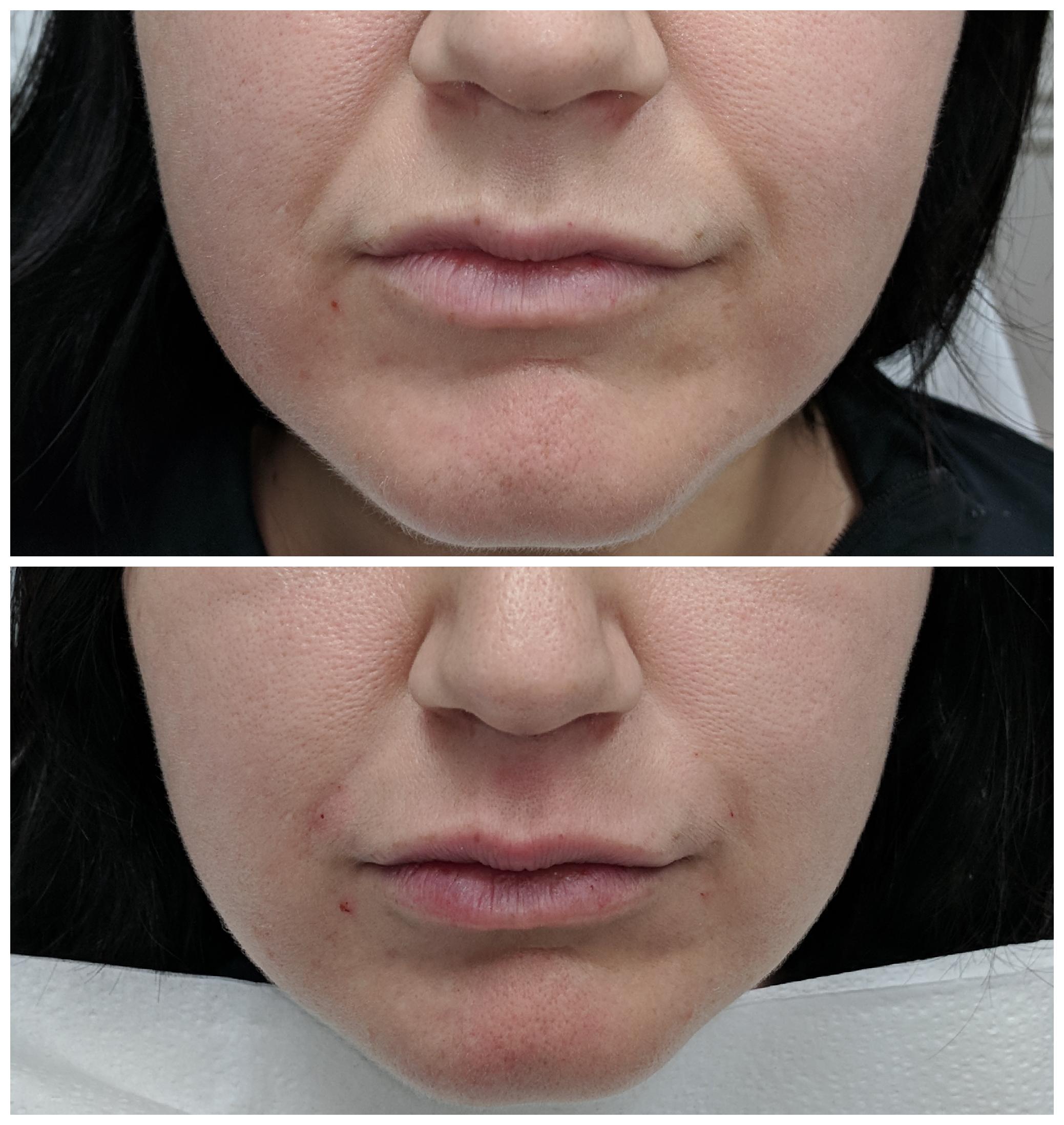 Fillers to lips and NLFs