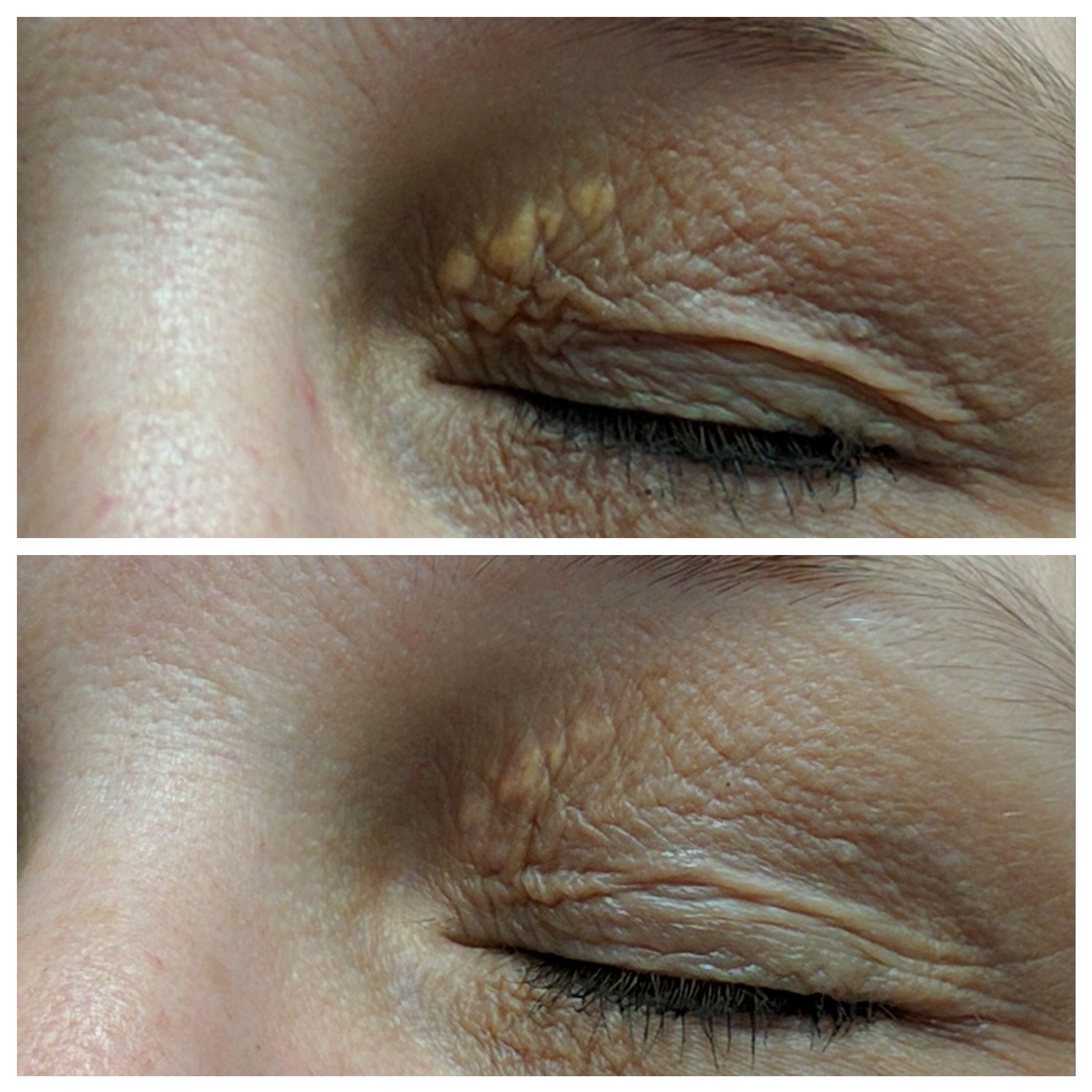treatment of xanthelasma