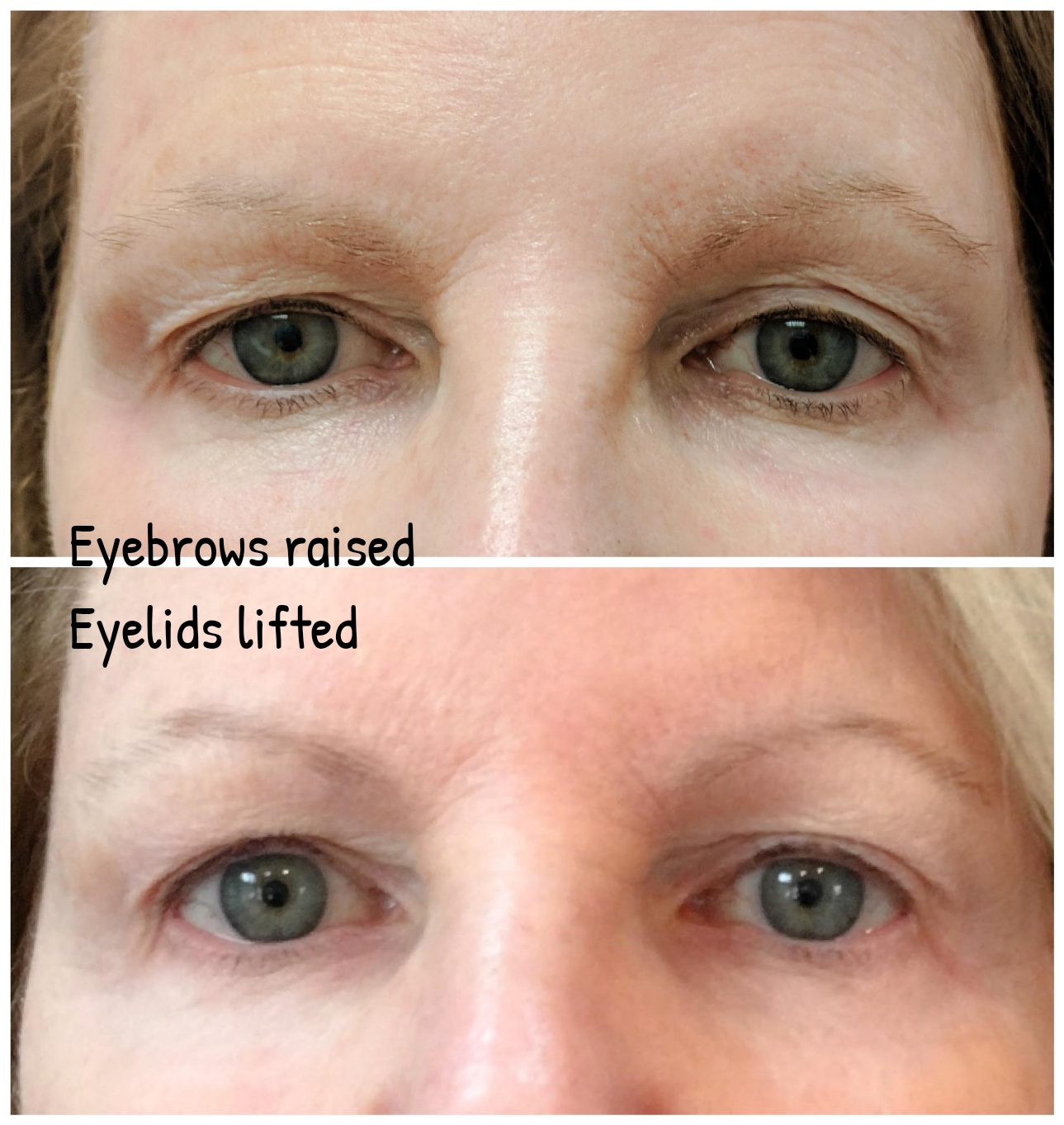 Fractora x 2 to lift eyes, rejuvenat