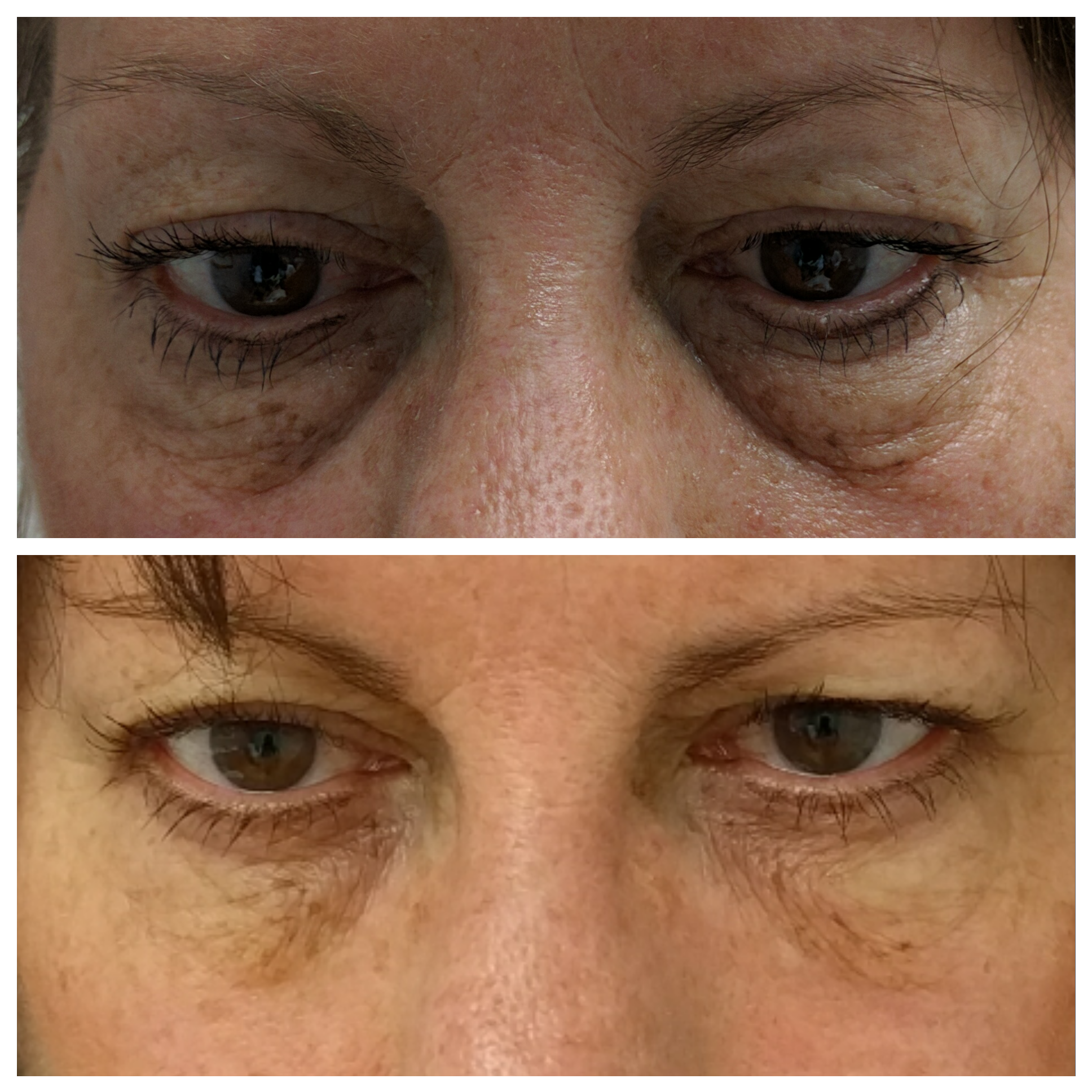 Fillers for under eye hollows