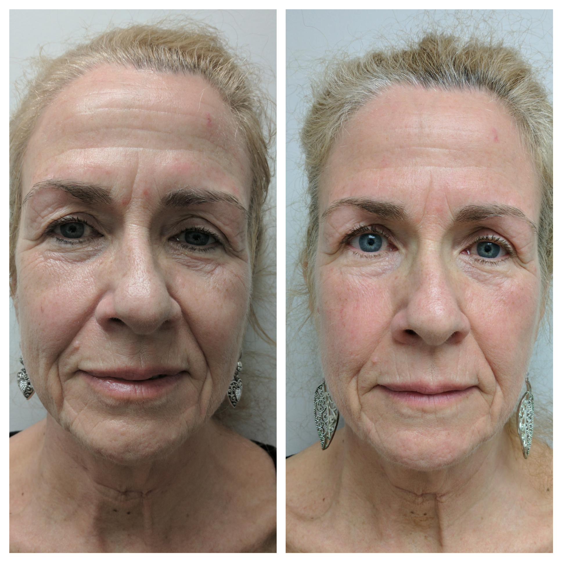 Skin Rejuvenation