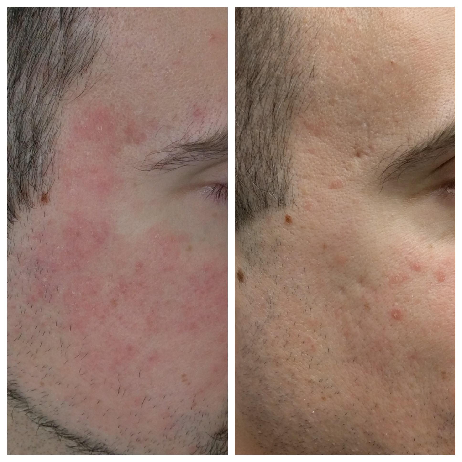 Fractora for rosacea