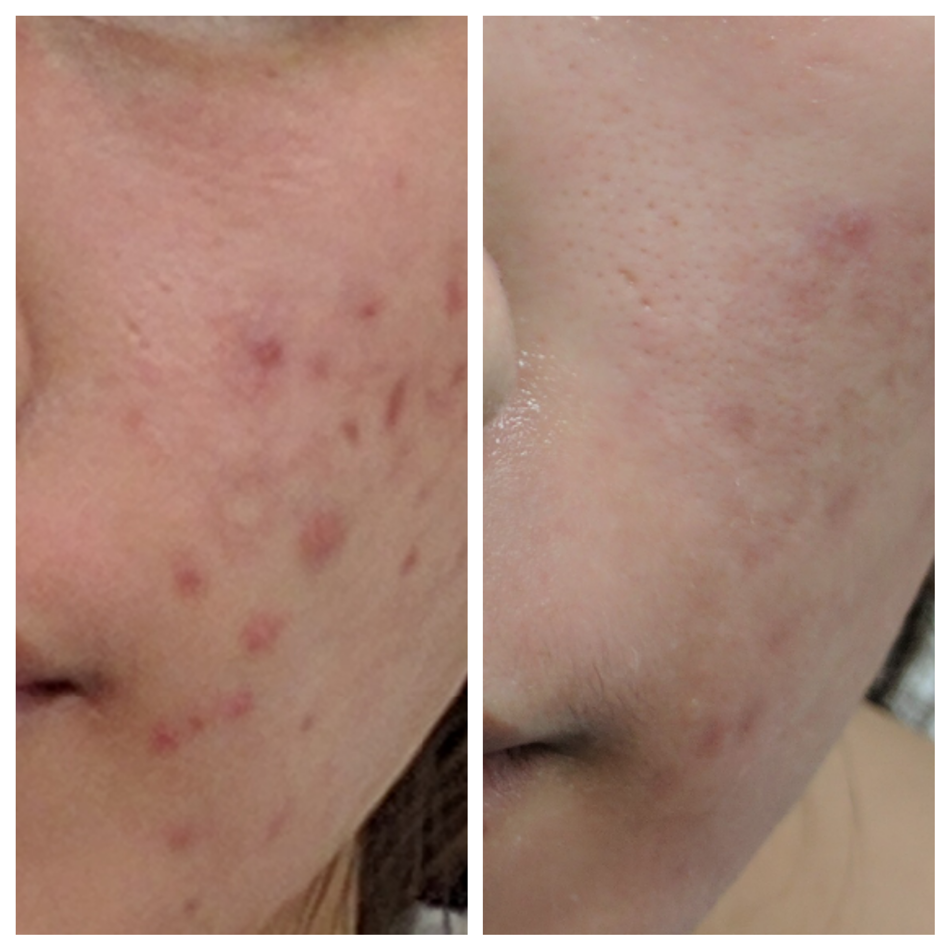 Fractora for active acne and scarrin