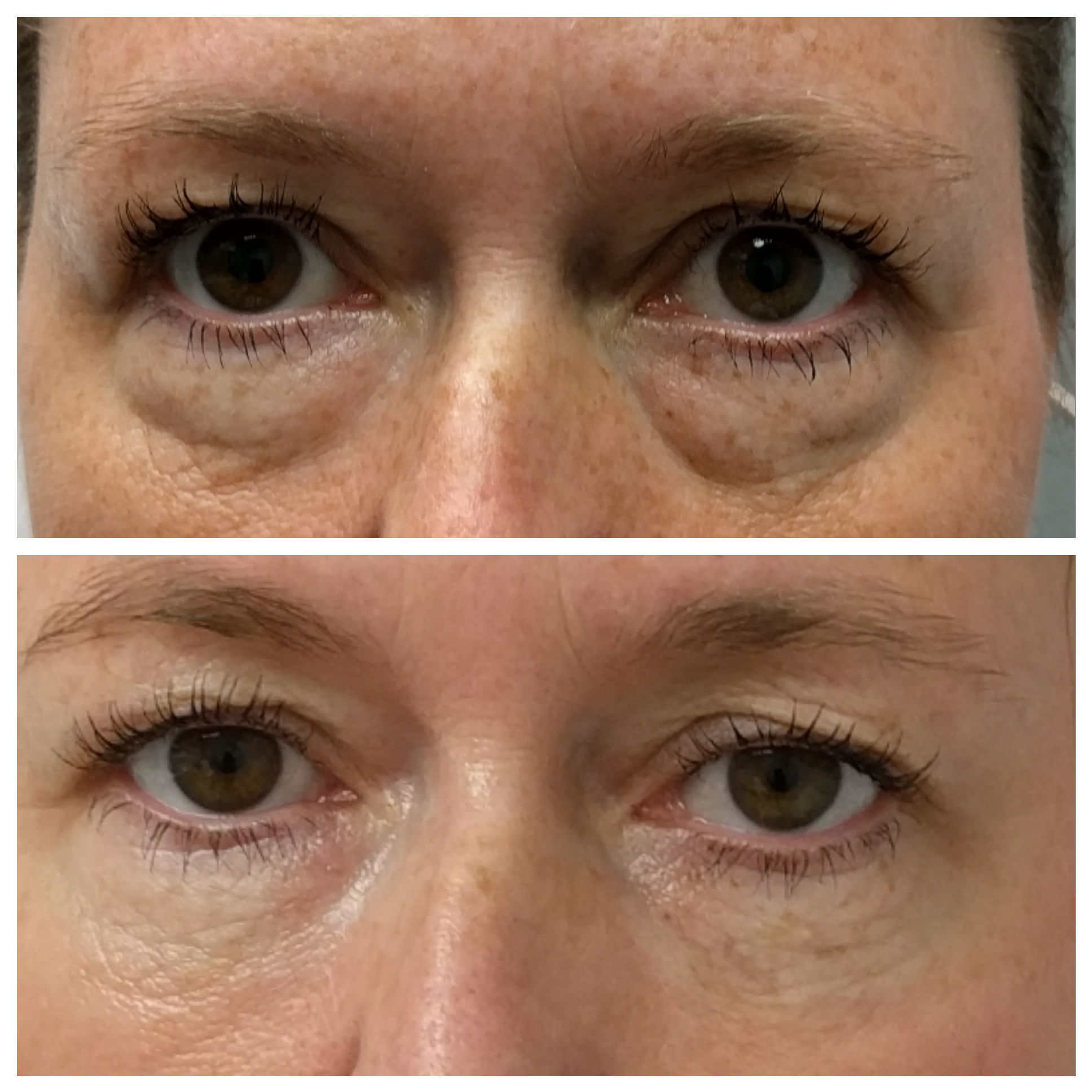 Fillers for under eye hollows