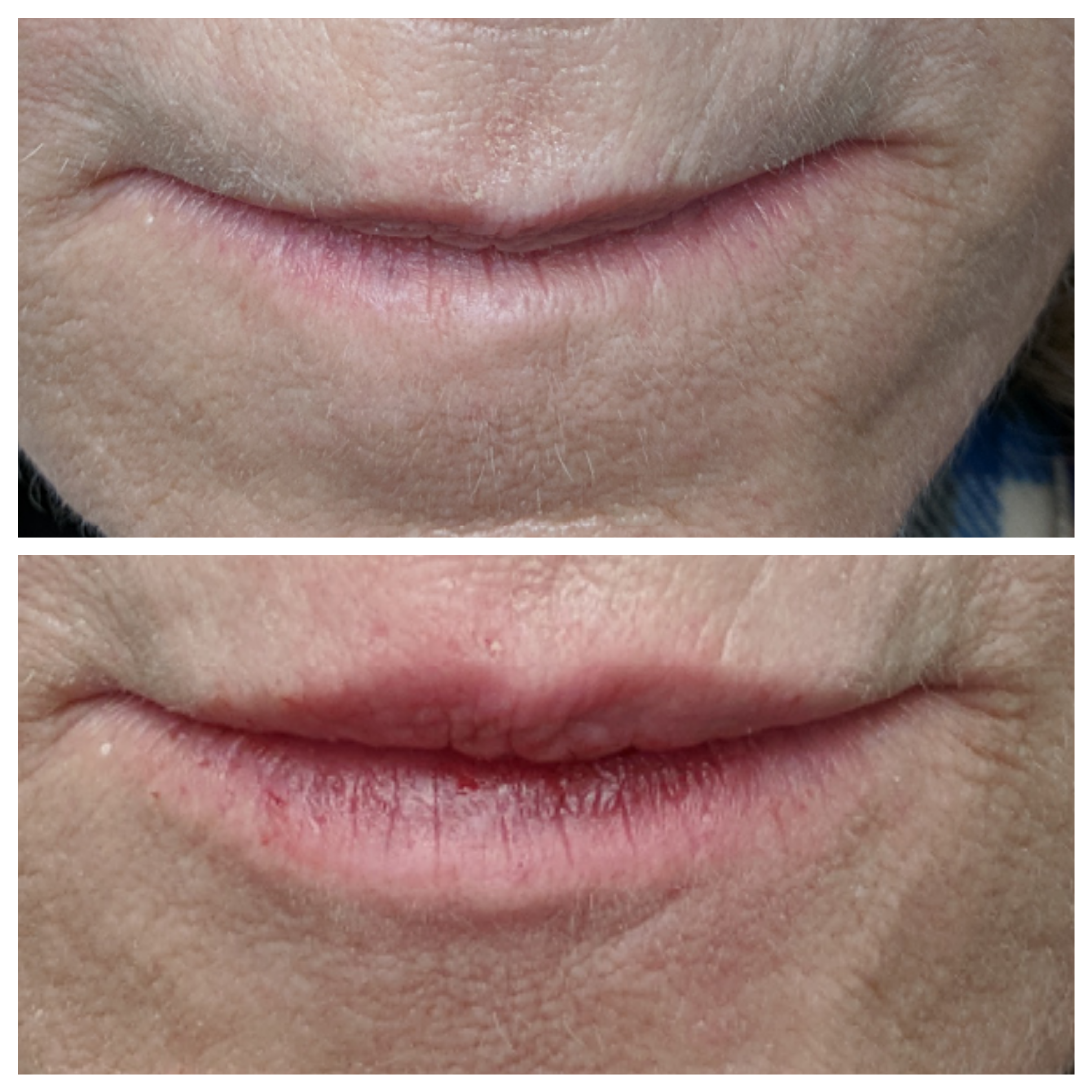 Fillers for lips