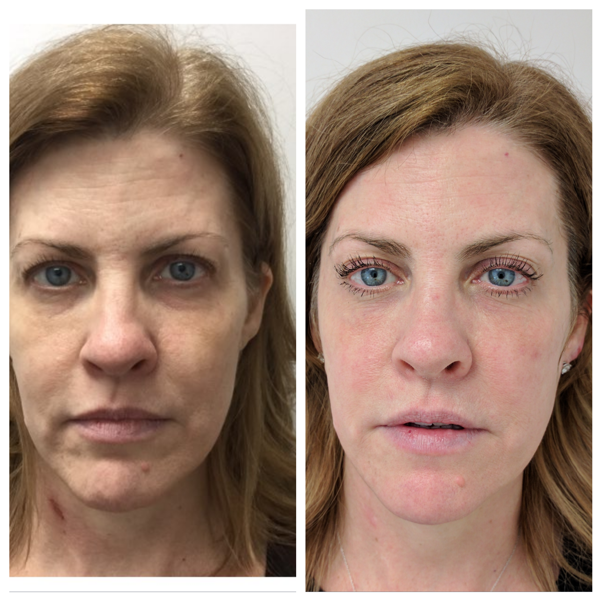 After 1 Fractora tx