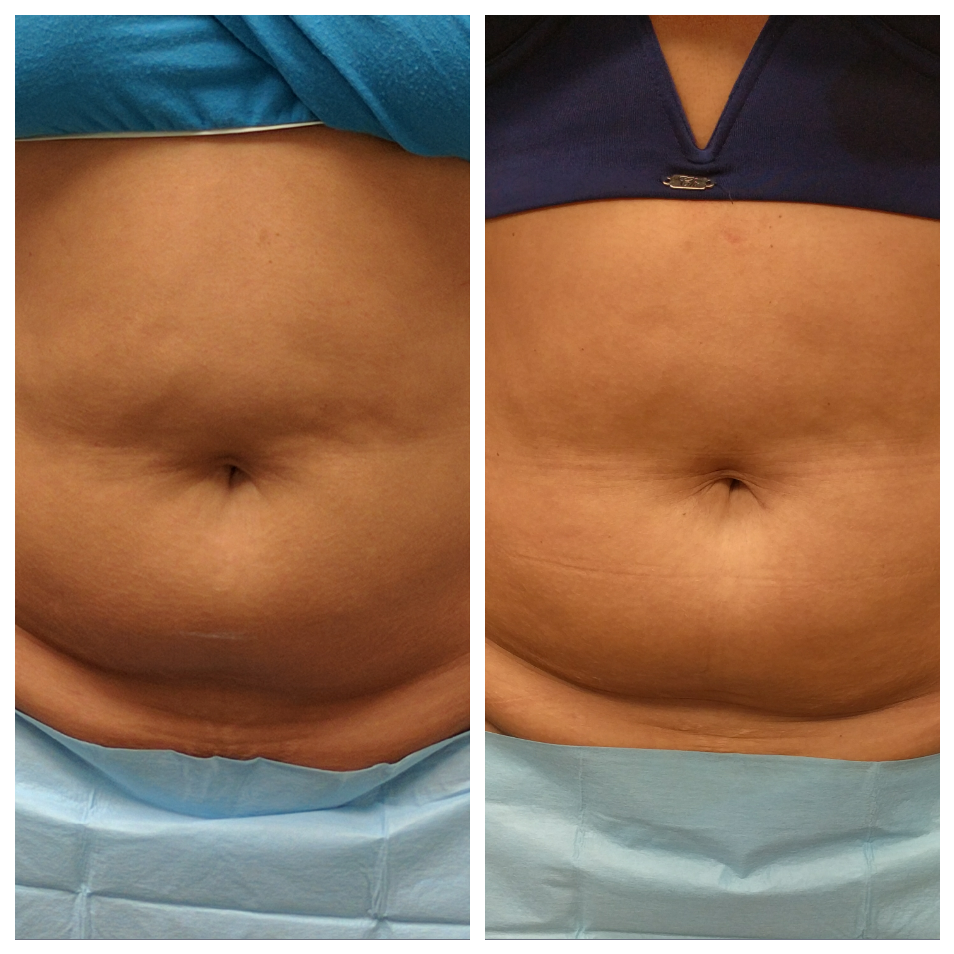 Ultrashape body contouring