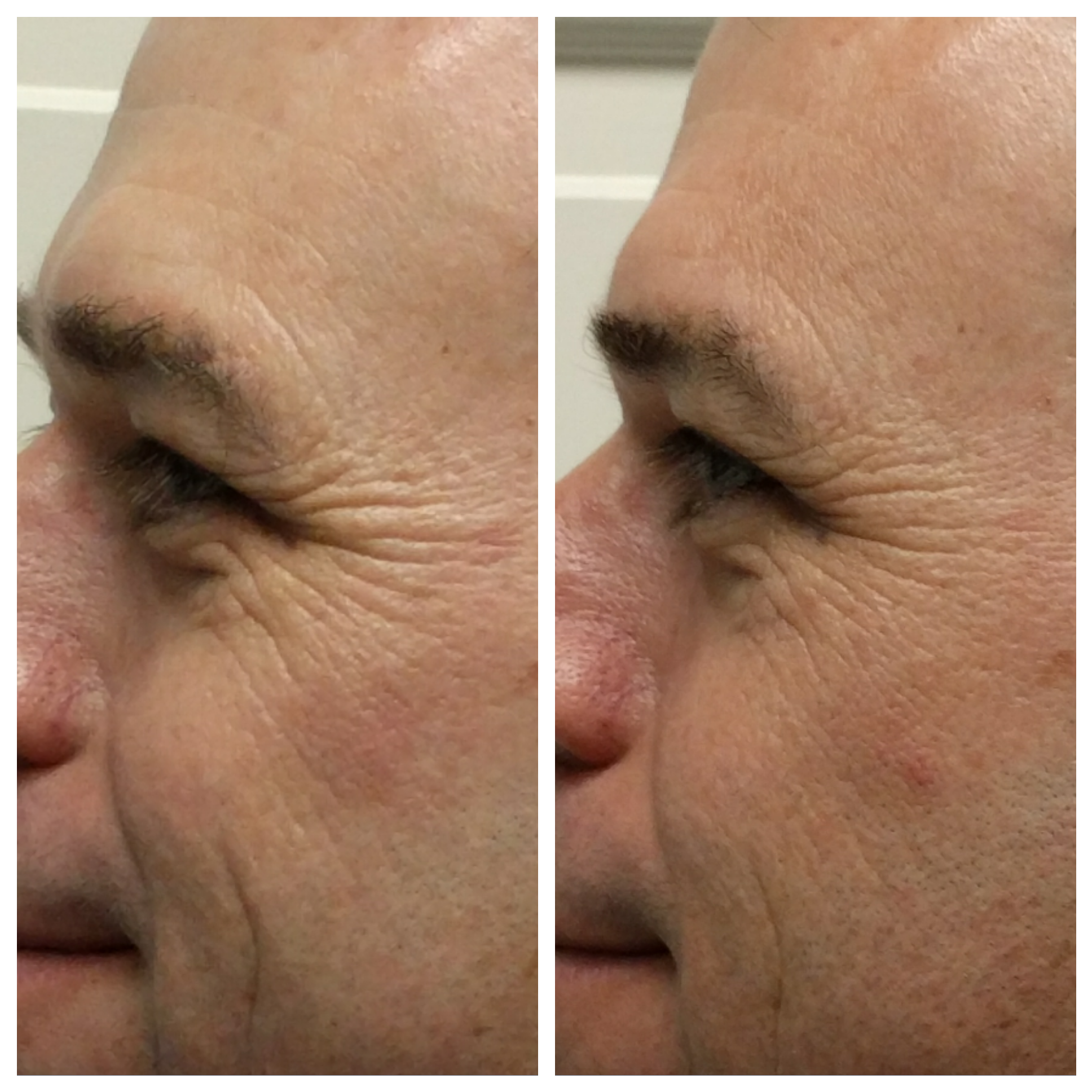 Fractora for crows feet