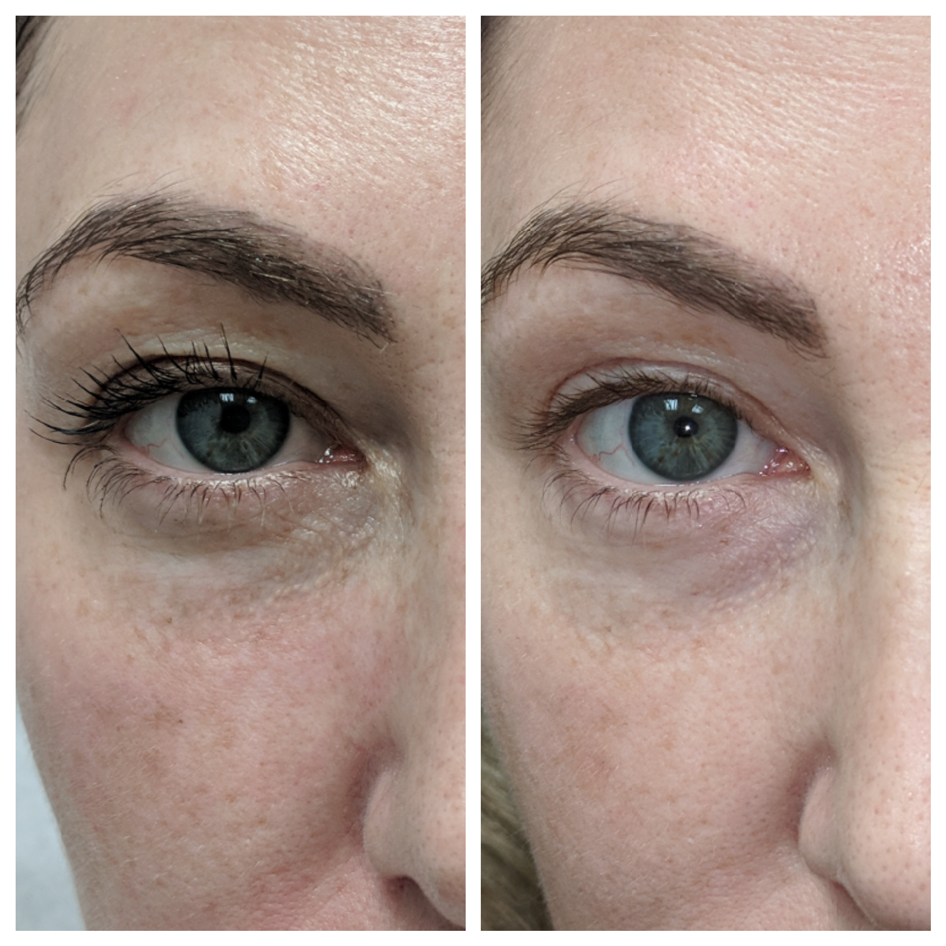 Fractora for natural lift of eyes