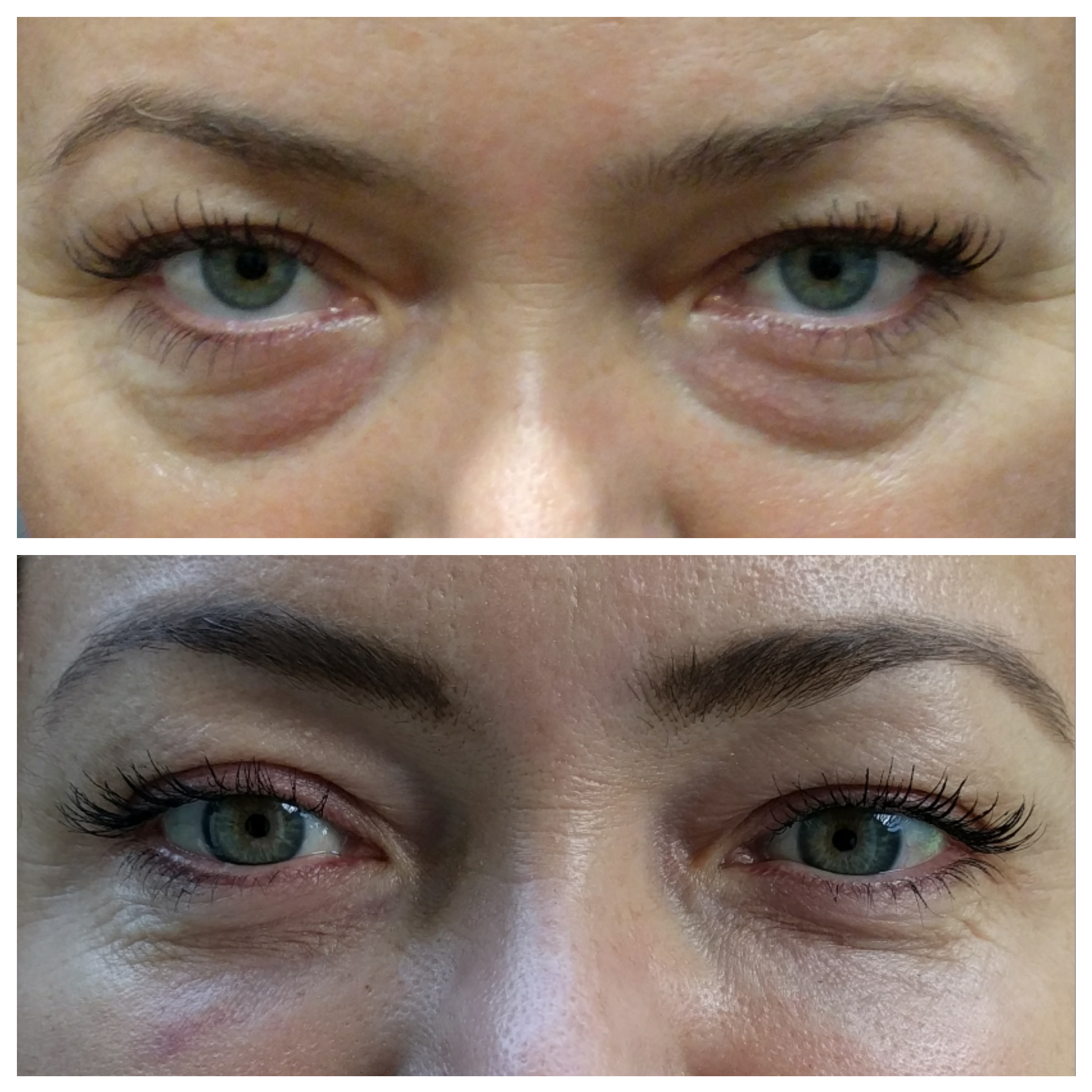 Fillers for under eye hollows