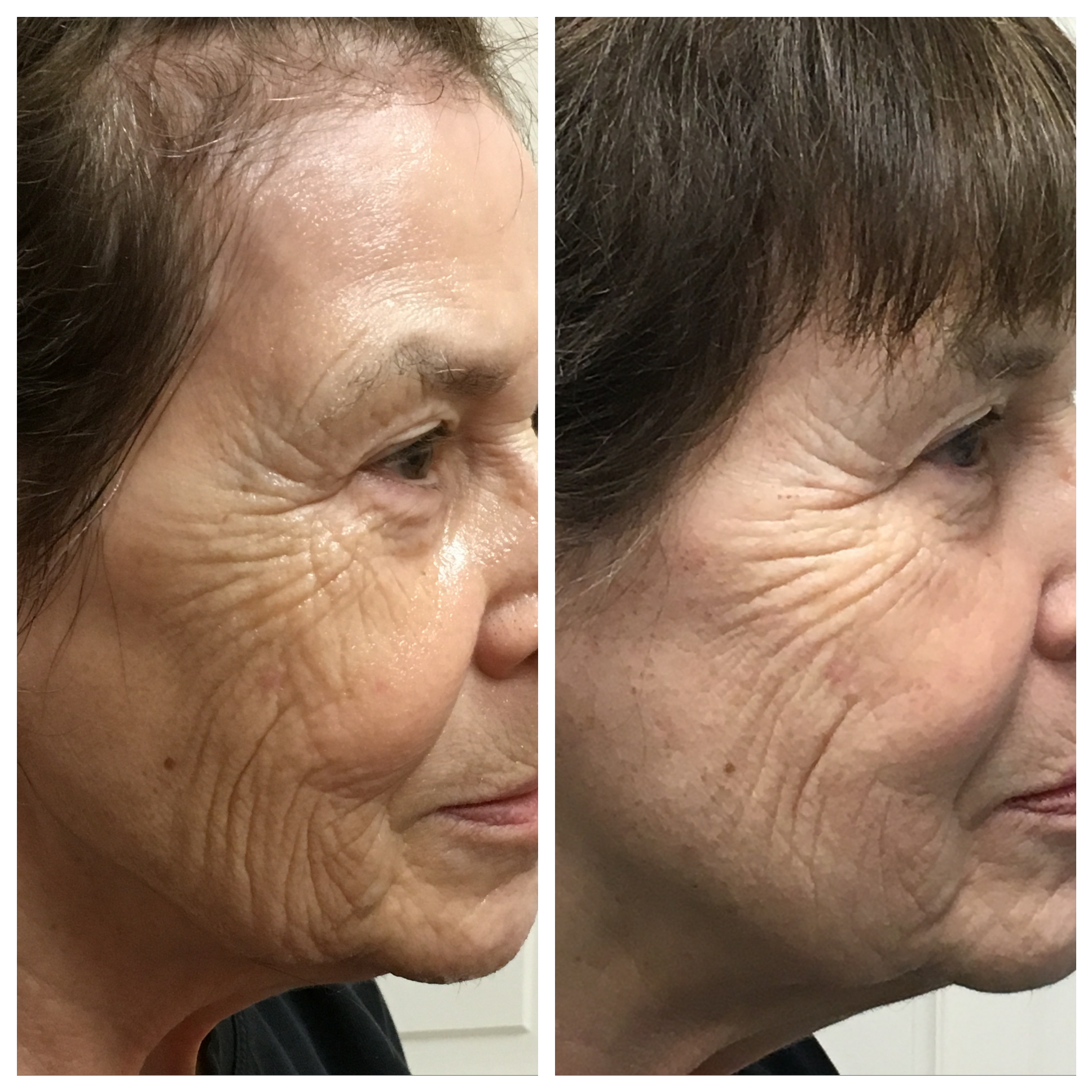 Fractora for rejuvenation