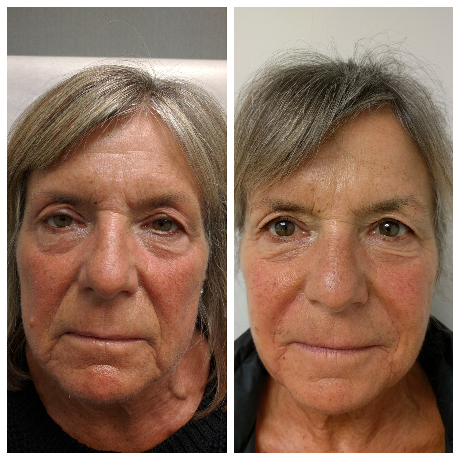 Fillers for instant results