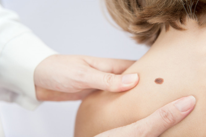 Birth Mark Removal