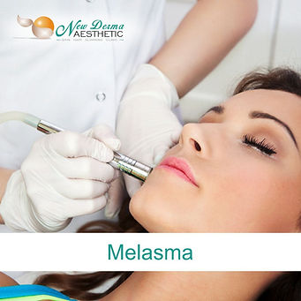 Melasma
