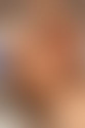 Microneedling Treatment at Newderma Aesthetic Clinic, Mira Road