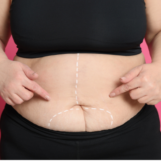 Cirurgias Reparadoras Pós-Bariátrica: Como Evitar Complicações e Acelerar a Cicatrização?