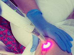 Laserterapia de Baixa Intensidade no Tratamento de Feridas