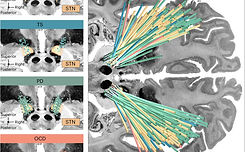Nature study explores the relationship between structure and functional impairments in the human brain