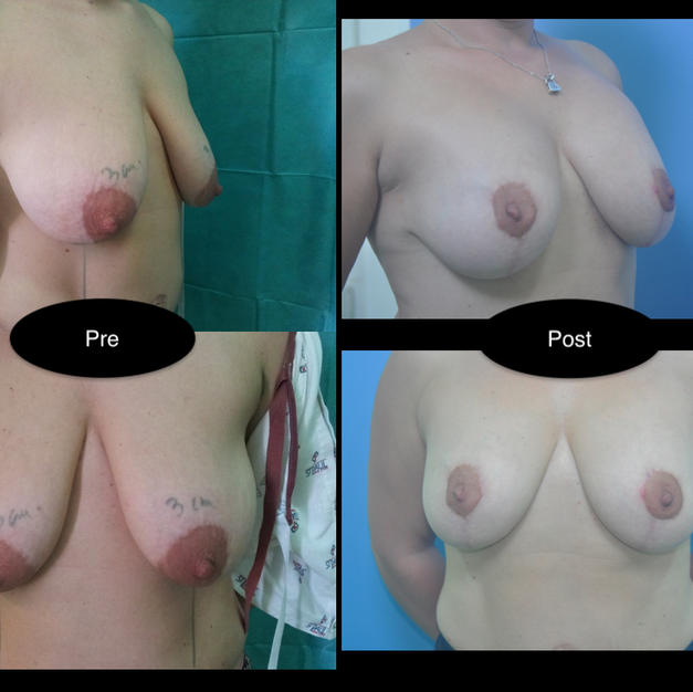 Mastopexie cu augmentare
