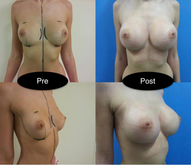 Augmentare