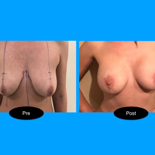 Mastopexie cu augmentare