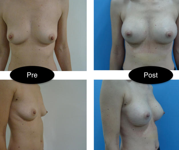 Augmentare
