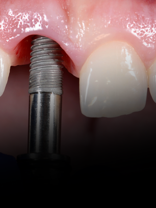 Tratamento SLA: A Importância crucial em parafusos de Fixação de Dispositivos Médicos Implantáveis