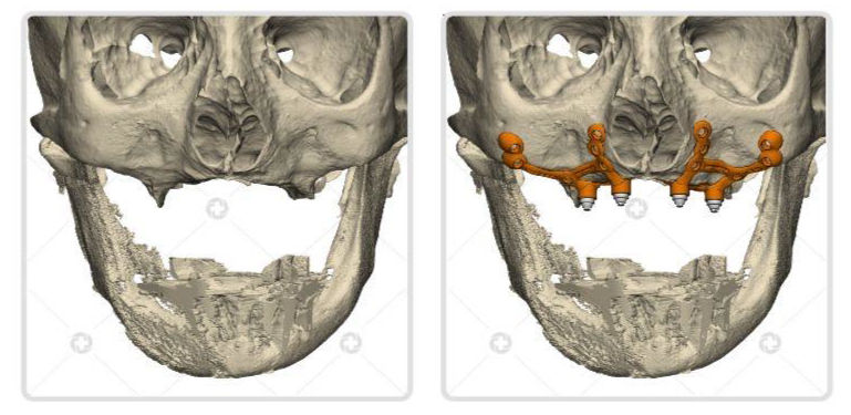 Treatment of the Atrophic Maxilla with Personalized Implants by CPMH: A Case Report
