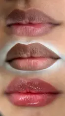 Lip Neutralization Before After Estetica Belle Pererenan, Bali