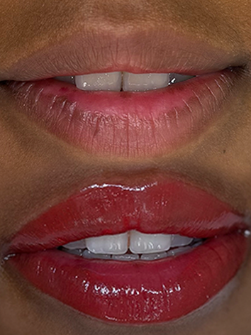 Lip Neutralization PMU