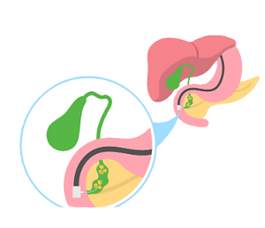 ERCP