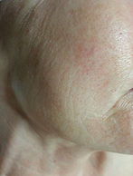 Before treatment at Skin Care Toronto