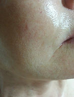 After treatment at Skin Care Toronto
