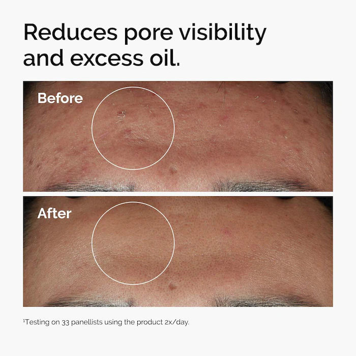 Thumbnail: Sérum Facial Niacinamida 10% + Zinco – Controle de Oleosidade e Antiacne