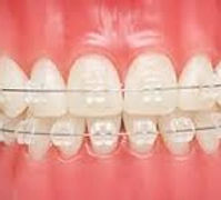 Ceramic Braces at the Orthodontist