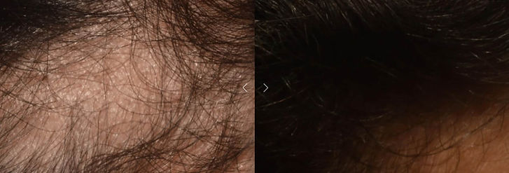 avant_apres_casque_chute_cheveux.jpg