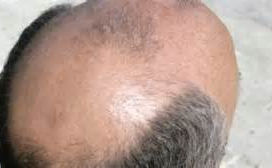 Balding Men-Increased Risk For Heart Disease