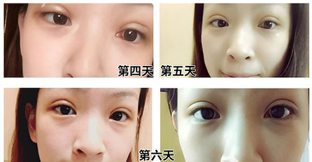 double eyelids (3)_edited.jpg