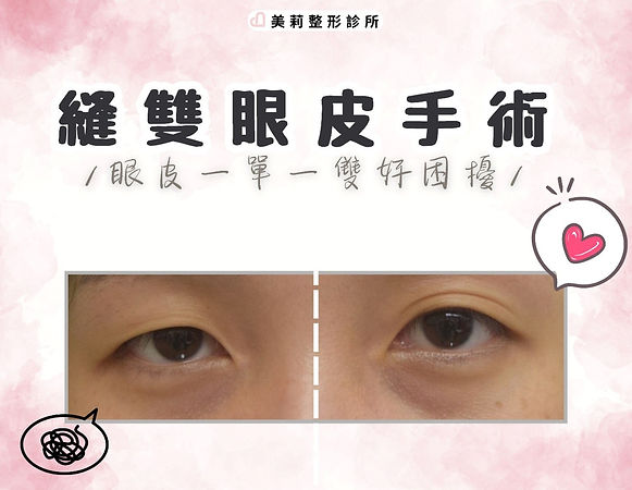 高雄縫雙眼皮
