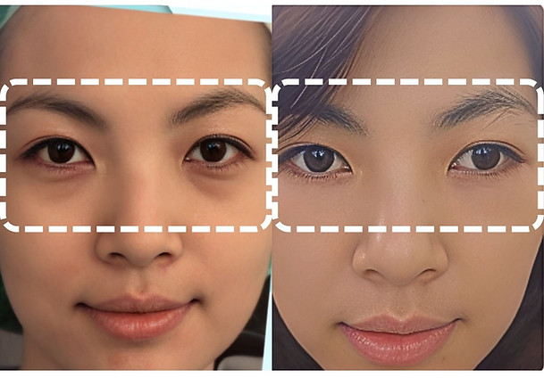 眼袋內開手術 (2).jpg