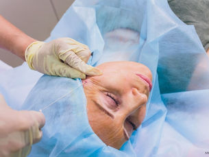 What Can a PDO Thread Lift Do for You?