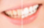 Teeth Whitening, bleaching