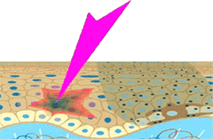 皮膚がんの原因