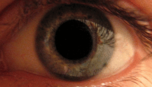 Eye_dilate-thumb_300px