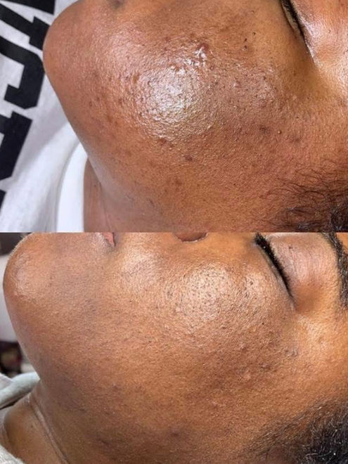 Before and after photo of a client with Grade 1 acne showing clearer skin, reduced bumps, and more even skin tone after professional treatment
