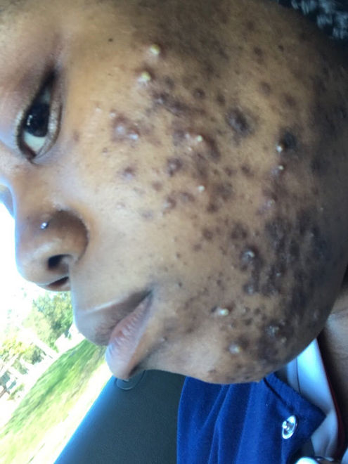 Close-up of inflamed acne with pustules and dark spots on client's cheek before professional skincare treatment