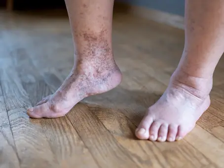 Pé Diabético: Cuidados Essenciais para Prevenir Complicações