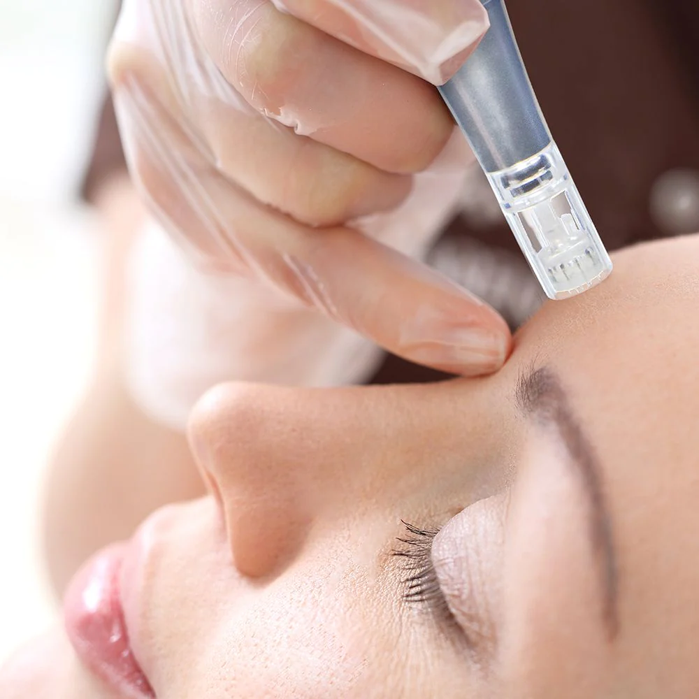 microneedling.WEBP
