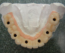 full mouth implants